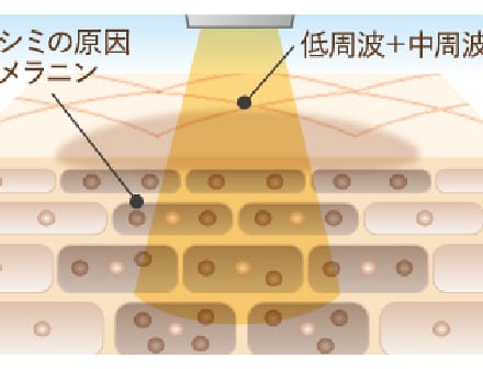 名古屋のシミ取りのメラニンケア